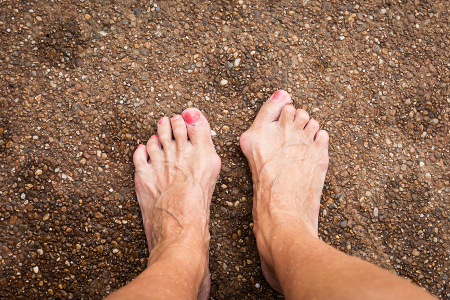 What Causes Hammertoes?